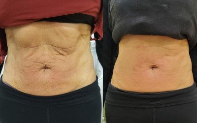 cavi-lipo before and after